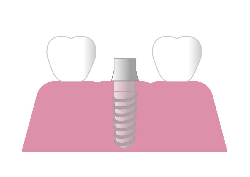 【知らないと損をする！？】インプラントの相場はいくら？