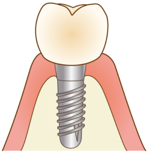 implant006