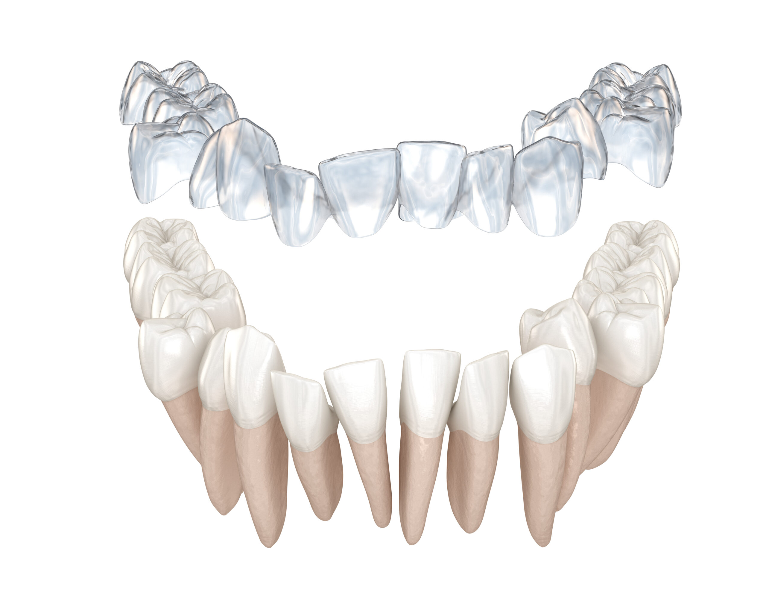 What are the Disadvantages of Mouthpiece Orthodontics? Advantages are also explained.