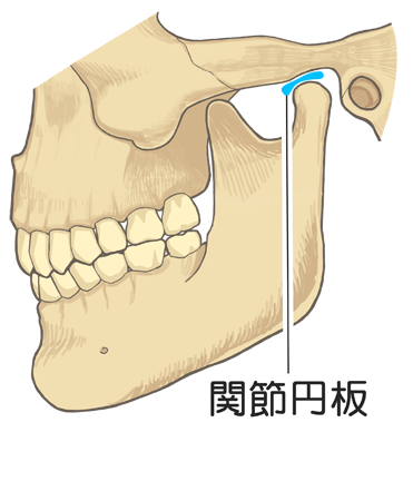 顎関節症とは？原因と治療法