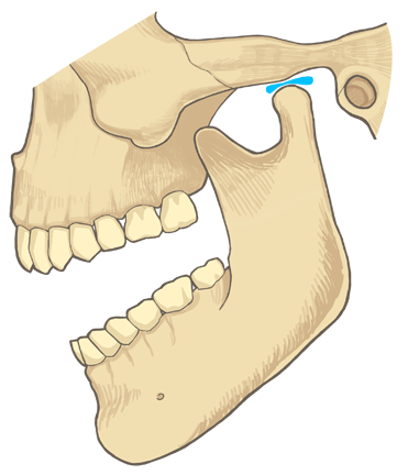 temporomandibular joint disorder