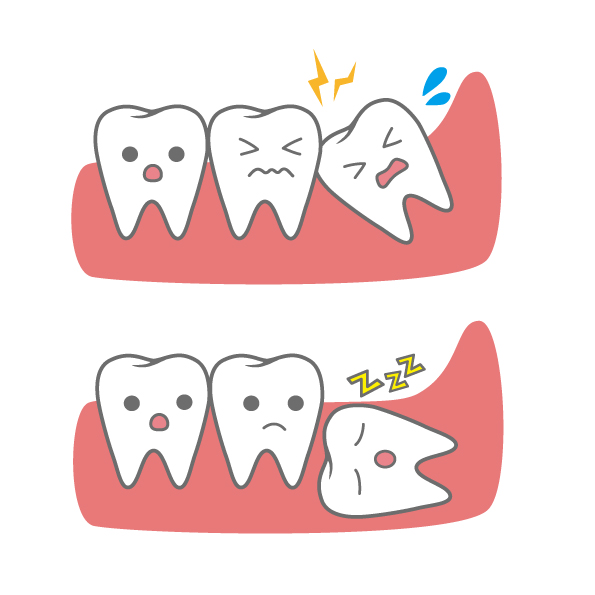 Wisdom tooth extraction Nerve