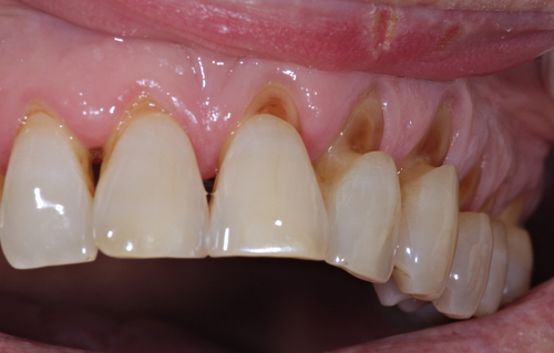 Tooth wear caused by over brushing Proper time to brush teeth