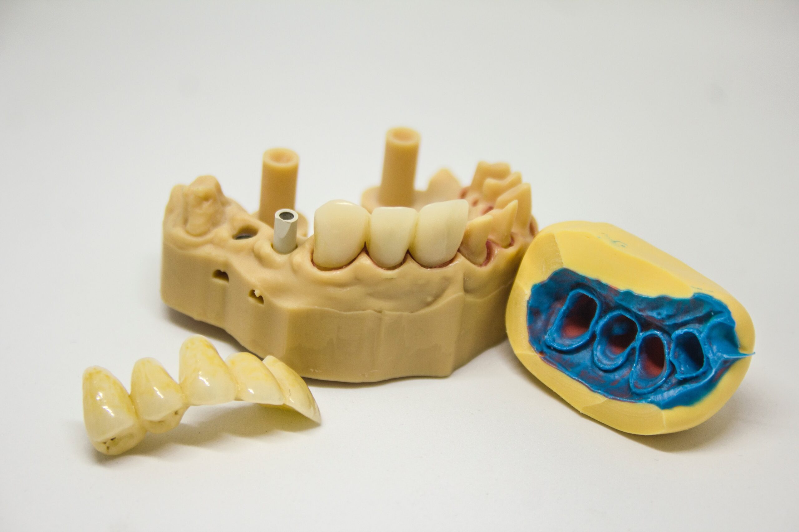 Which celebrities have front teeth bridges? Cost and treatment of front tooth bridges.