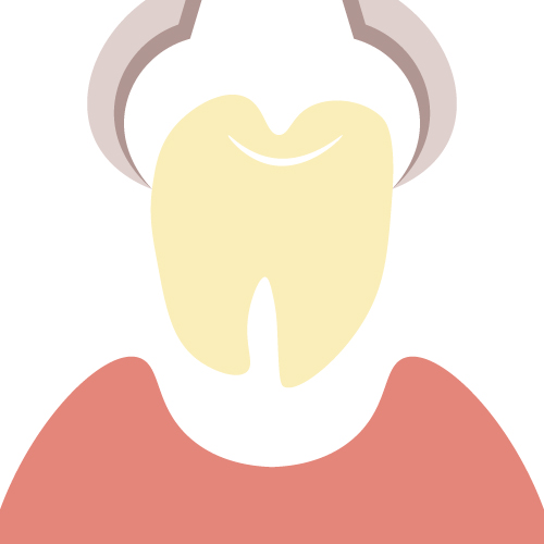 Dentist Supervisor] What is the white pudendum after tooth extraction?