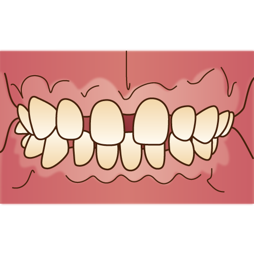 Sagging teeth Orthodontics