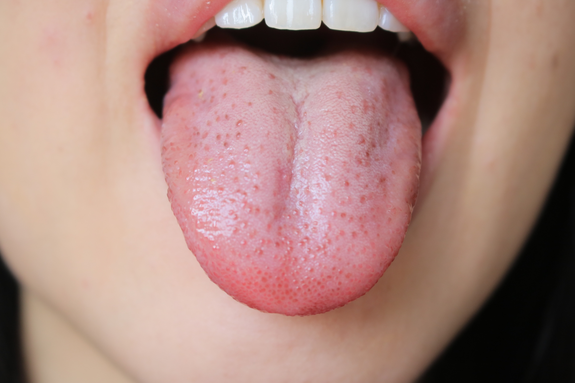 Is a white tongue a disease? We will tell you why it is white and how to get it off and back!