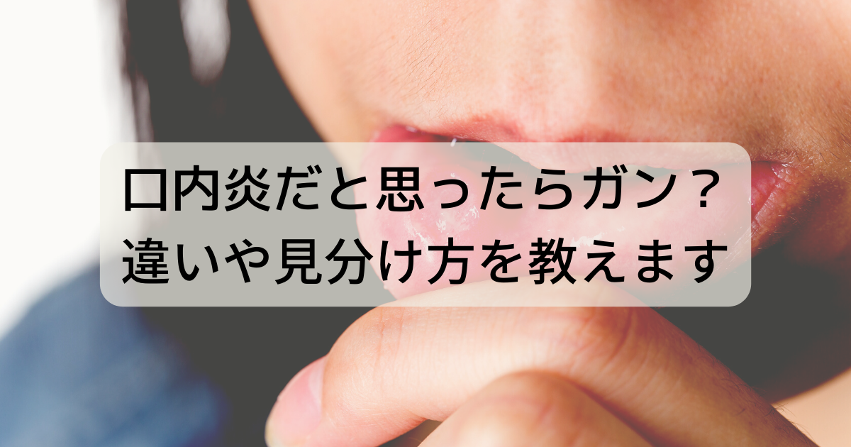 口内炎だと思ったらガン？違いや見分け方を教えます。