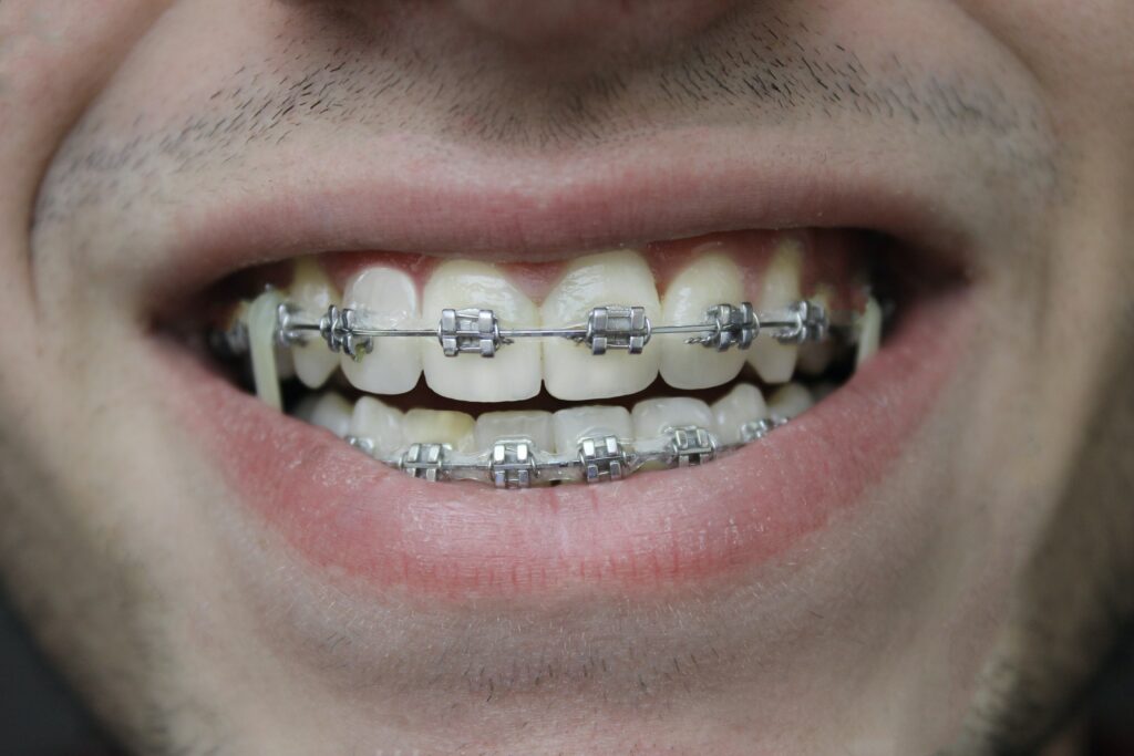 Orthodontic Bracket dislodged