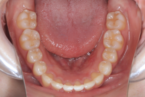 10 case 1 postoperative mandible 300x200 1