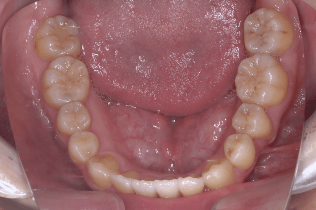 10 case 4 postoperative mandible 1024x683 min