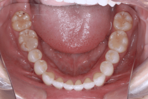 10 case 6 postoperative mandible 300x200 1 min