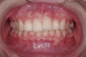 1 case 1, preoperative frontal view, 300x200 min