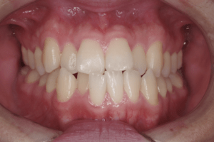 1 case 4, preoperative frontal view, 300x200 min