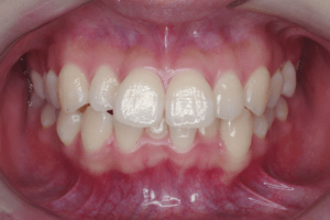 1 case 5 preoperative frontal view 300x200 min