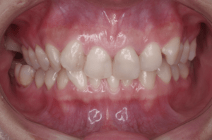 1 case 6 preoperative frontal view 1 1 300x199 min