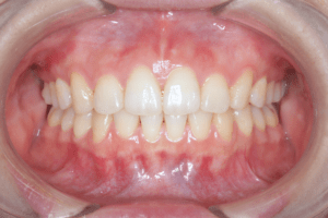 2 cases 1 postoperative frontal view 300x200 min