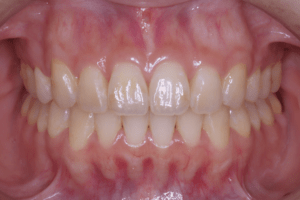 2 case 2 postoperative frontal 2 1 300x200 min