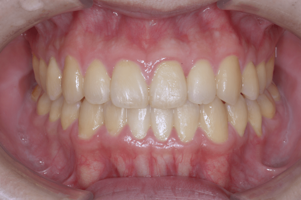 2 case 4 postoperative front view 1024x683 min