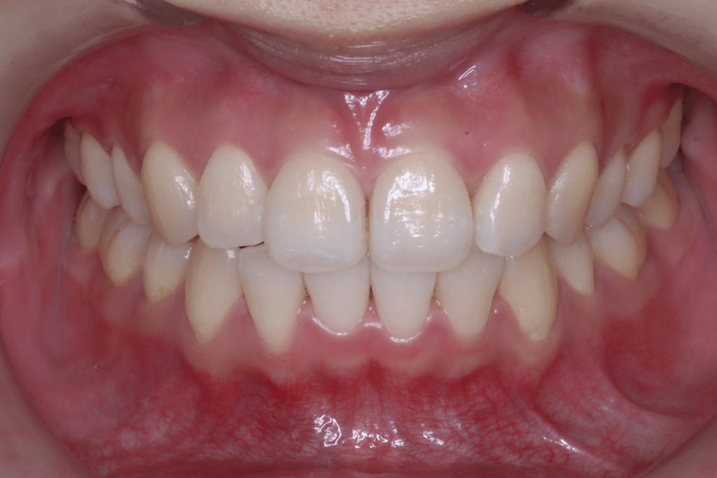 2 case 5 postoperative frontal view 1 1024x683 min