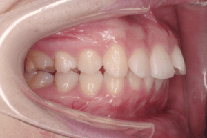 3 case 1 preoperative right 300x200 min