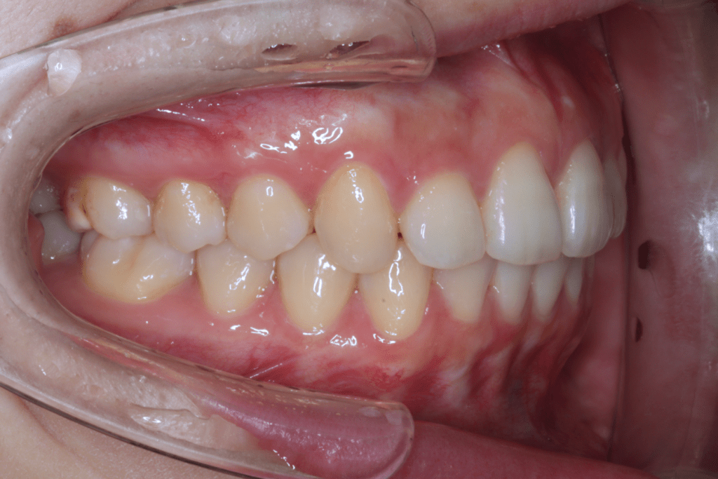 4 case 1 postoperative right 1024x683 min 1