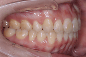 4 case 2 postoperative right 2 300x200 min