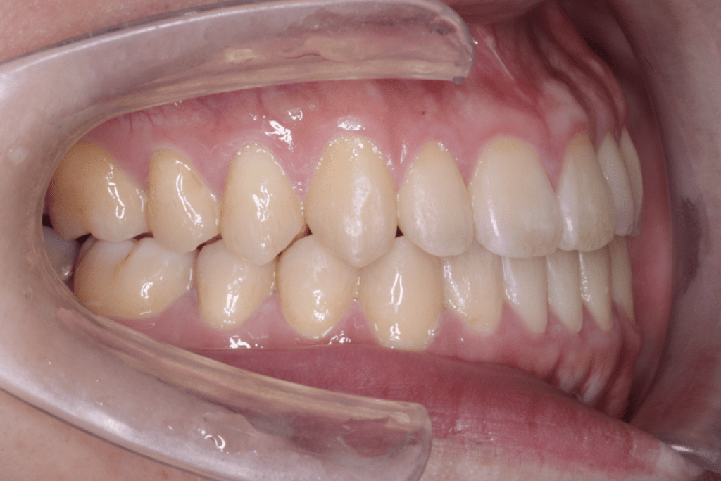 Case 4, postoperative right 1024x683 min