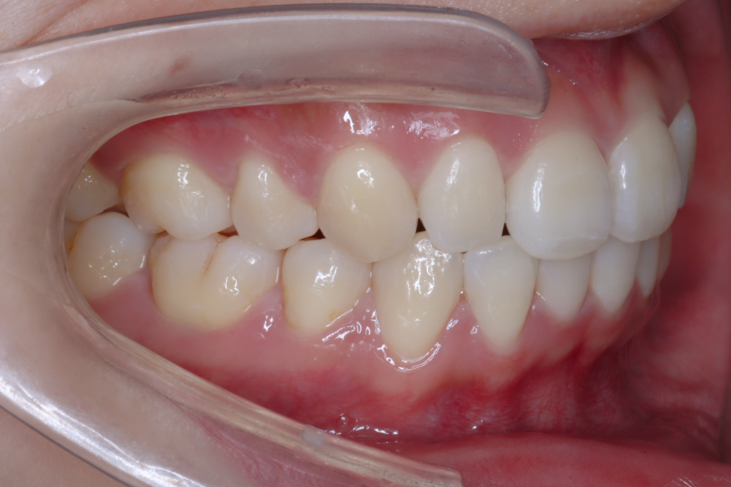 4Case 5 Postoperative right 1 1024x683 1