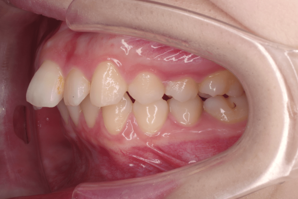 5 case 1, preoperative left 1024x683 min