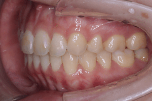 6 case 2 postoperative left 2 300x200 min