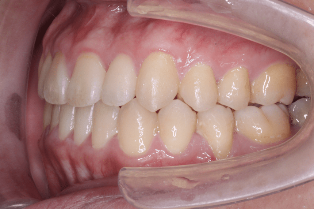 6 case 4 postoperative left 1 1024x683 min