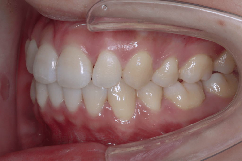 6 case 5 postoperative left 1024x683 min