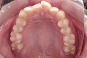 7 case 1 preoperative maxilla 300x200 1