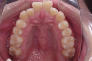 7 case 4 preoperative maxilla 300x200 min