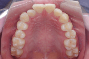 7 case 5 preoperative maxilla 300x200 min