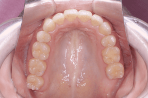 8 case 2 postoperative upper 300x200 min