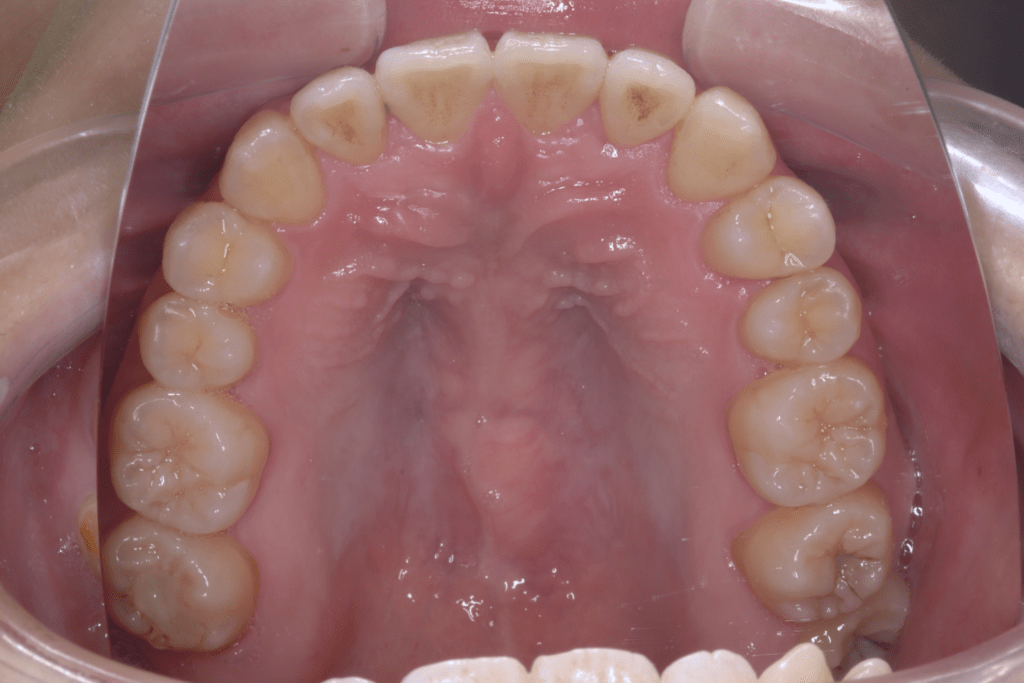 8 case 4 postoperative maxilla 1 1024x683 min