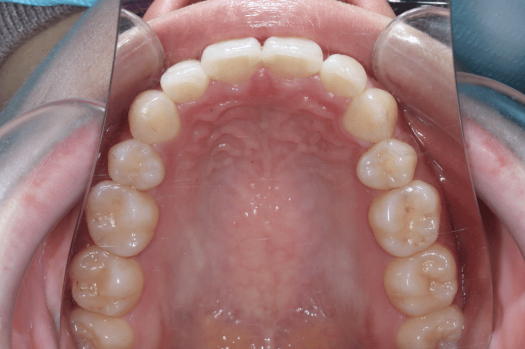 8 case 5 postoperative maxilla 1024x682 min