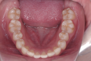 9 case 1 preoperative mandible 300x200 1