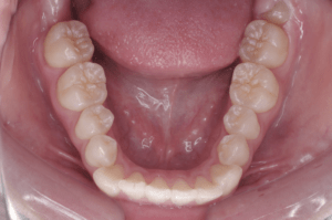 9 case 2 postoperative lower 2 300x199 min