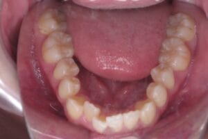 9 case 4 preoperative mandible 300x200 min