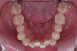 9 case 5 preoperative mandible 2 300x200 min