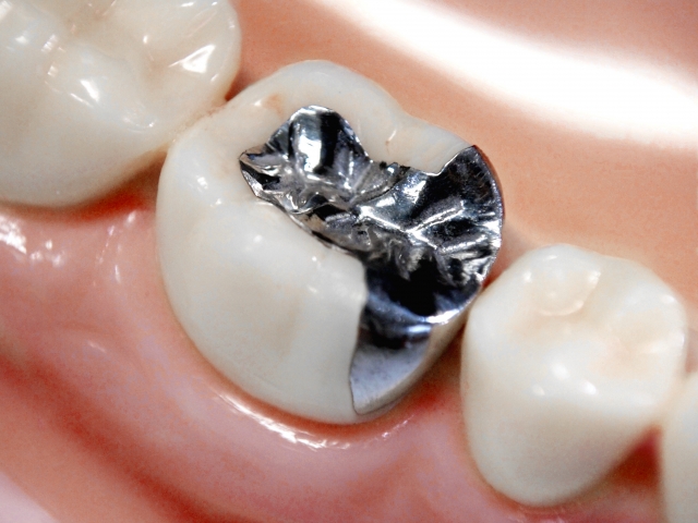 Silver teeth, metal allergy, insurance coverage