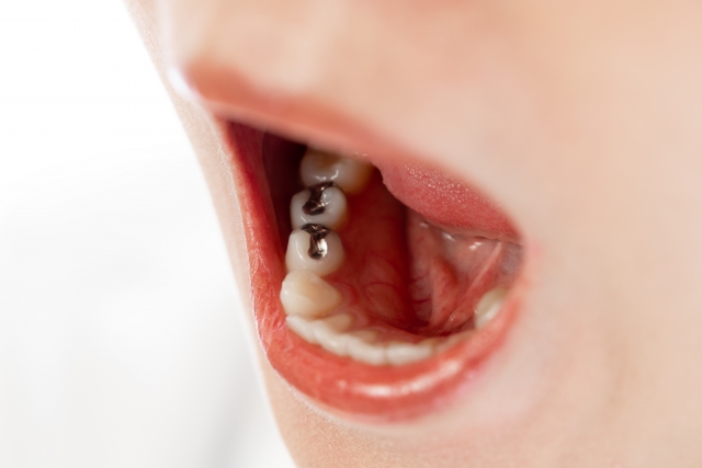 What causes the lower teeth to be misaligned?