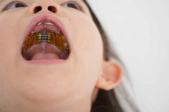 What Happens When the First Phase of Childhood Orthodontic Treatment is Stopped? Advantages and Disadvantages Explained