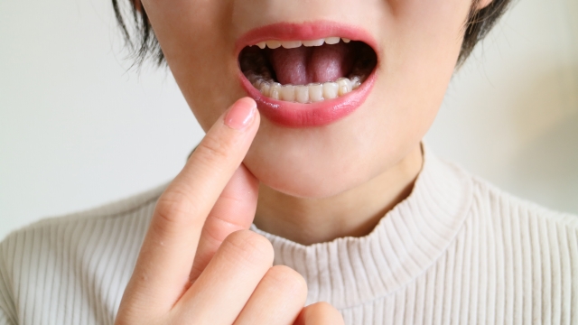 What are Invisalign attachments? Explaining its role, advantages and disadvantages.